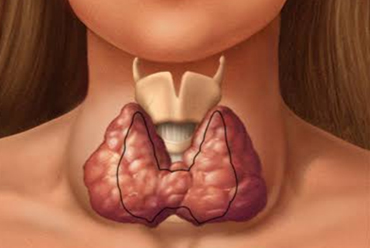 best thyroid doctor in delhi